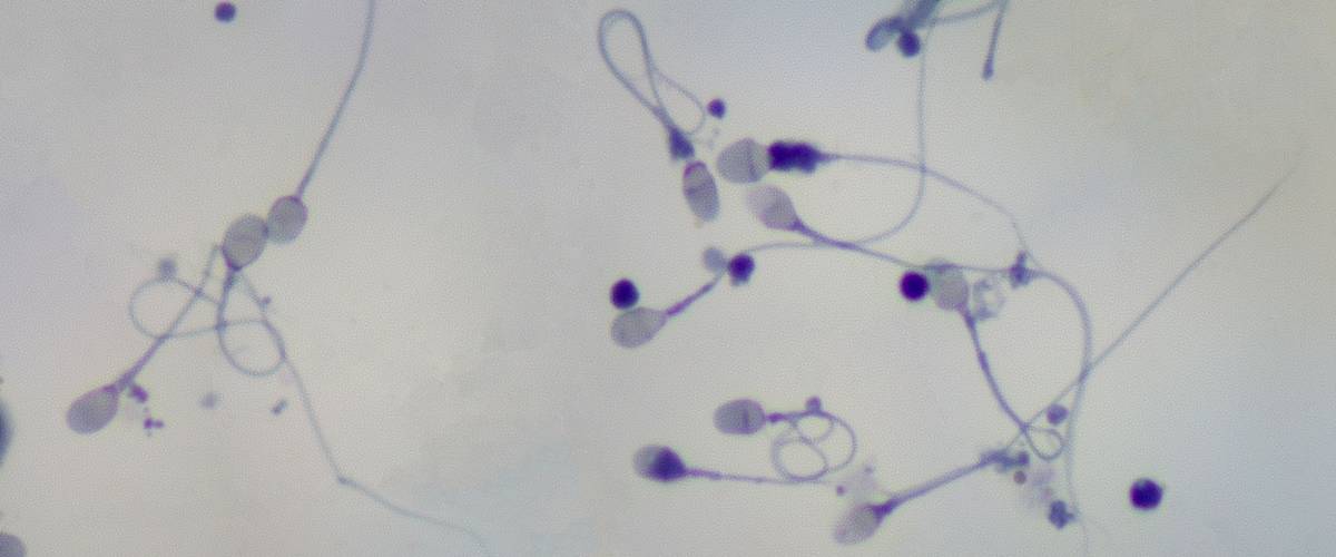 real Human Sperm and cell bodies photomicrograph viewed under a 100x objective. Panorama.