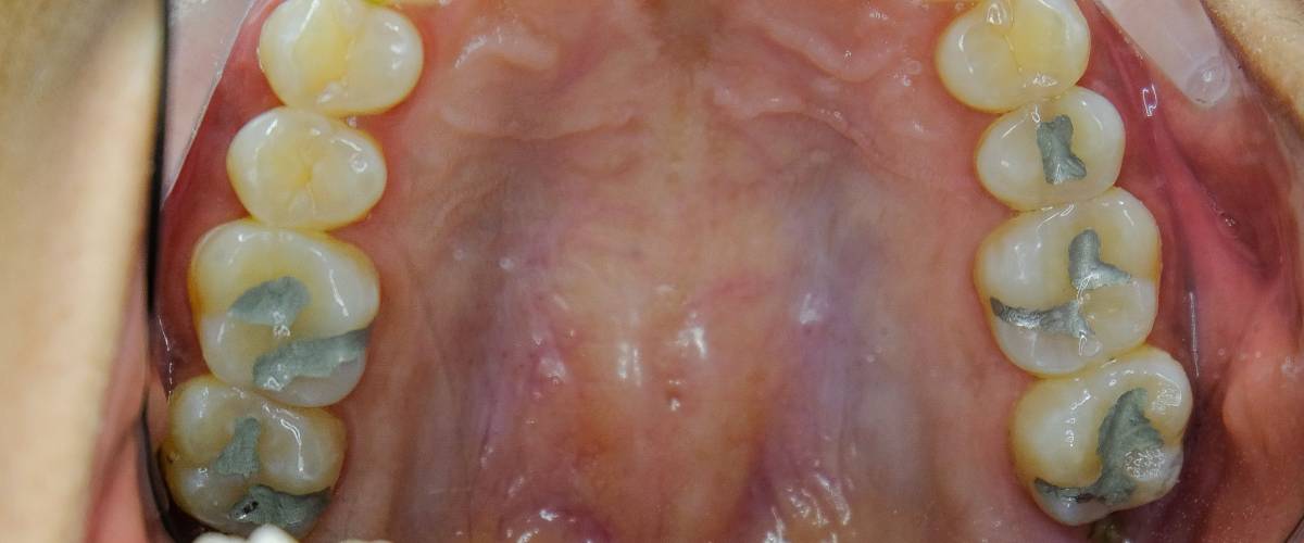 tooth filling with amalgam