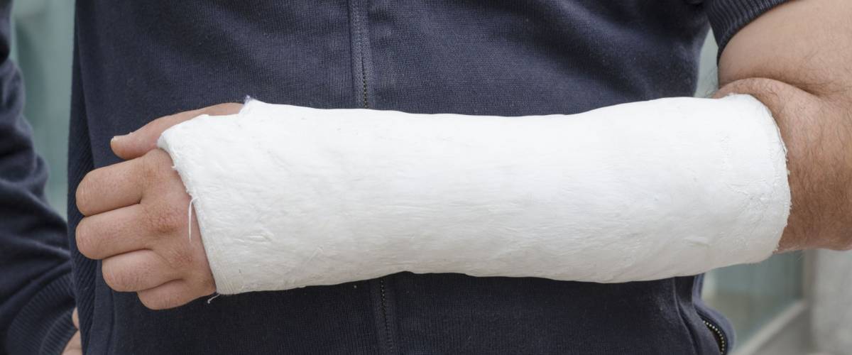 Man with his broken arm. Arm in cast, face not visible.